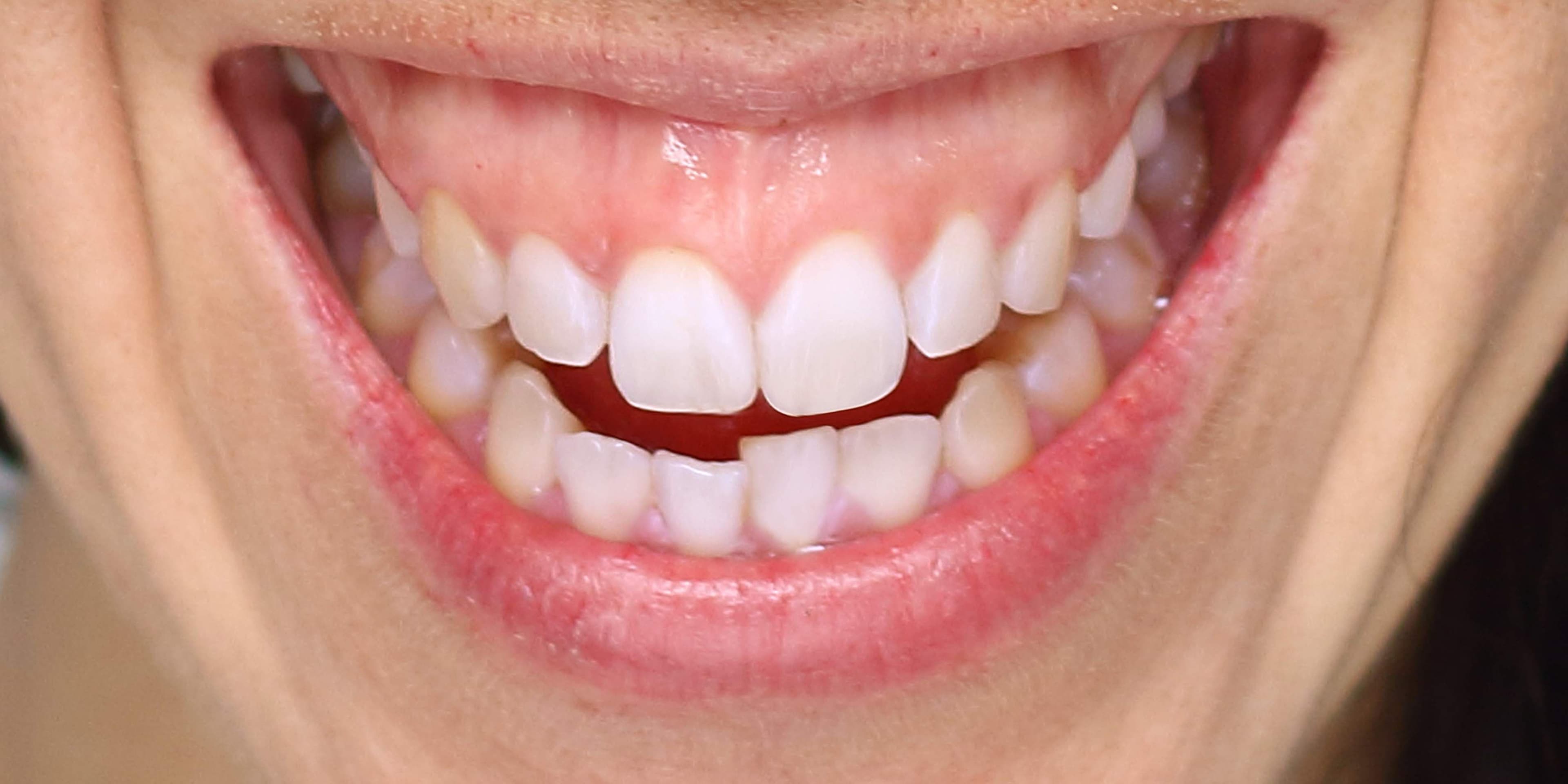 gummy smile correction.jpg