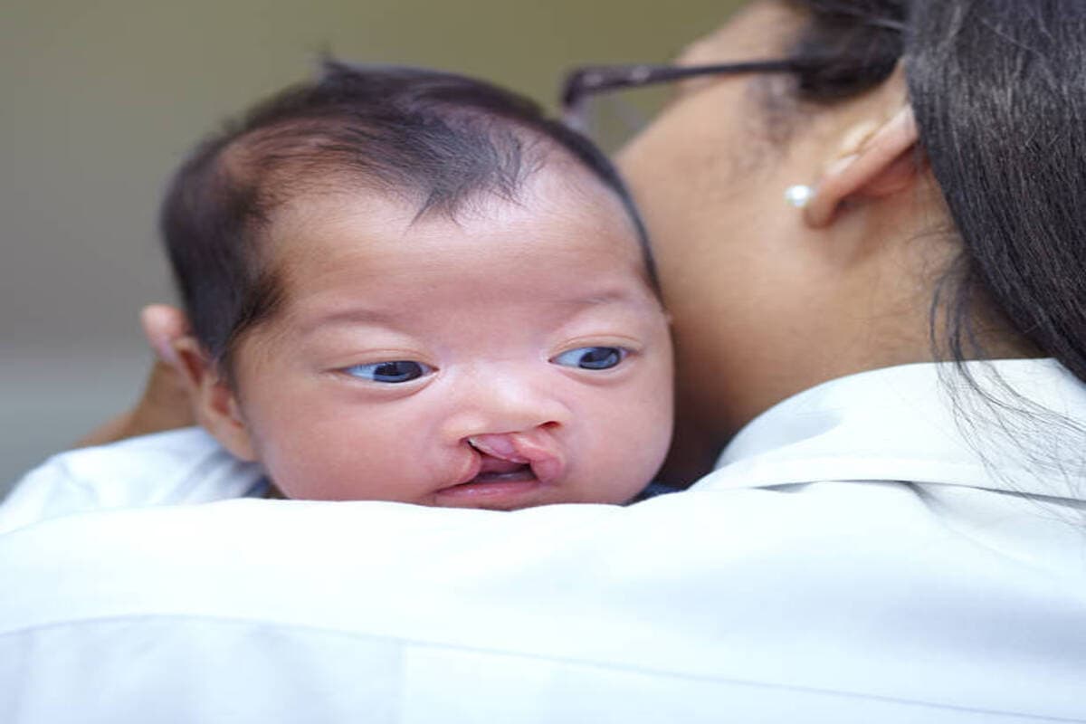 Now - Cleft Lip, Baby
