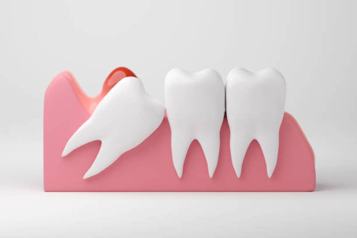 How Long Does It Take for Wisdom Teeth to Heal