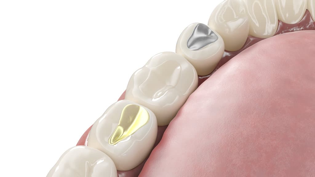 How Long Do Fillings Last