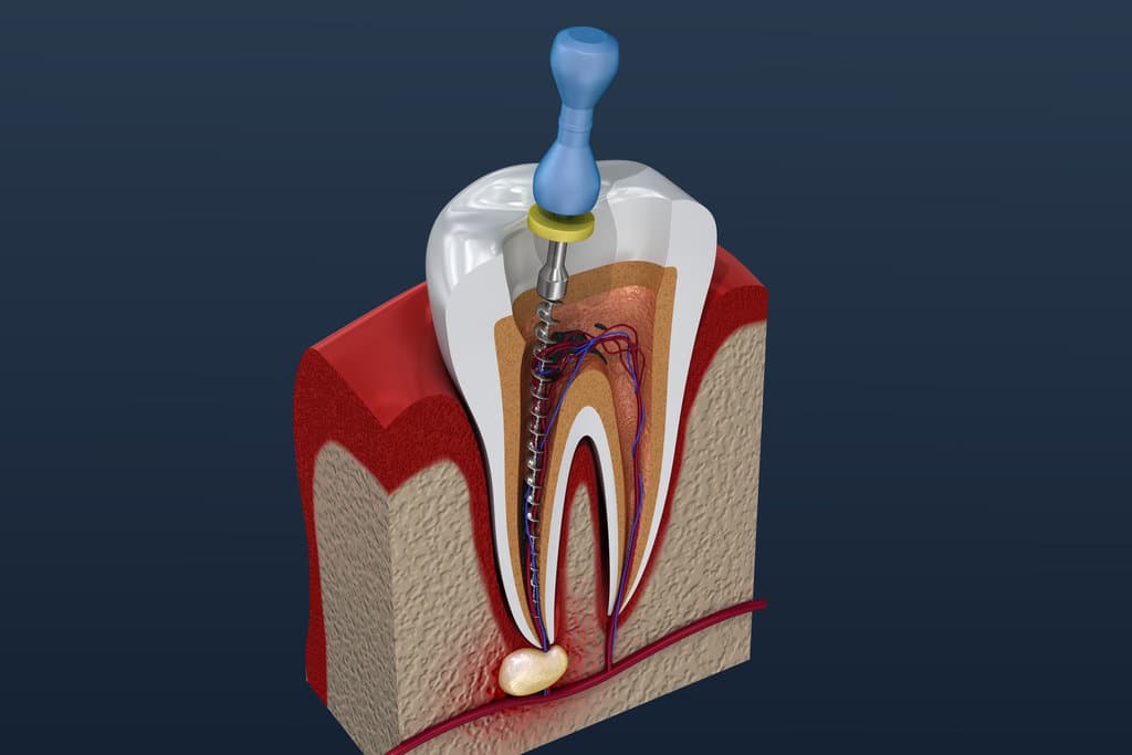 What Causes Root Canal