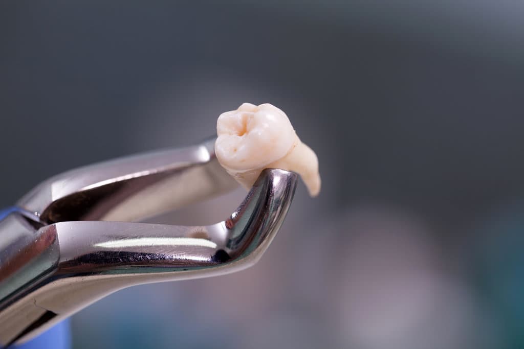 Infection After Tooth Extraction