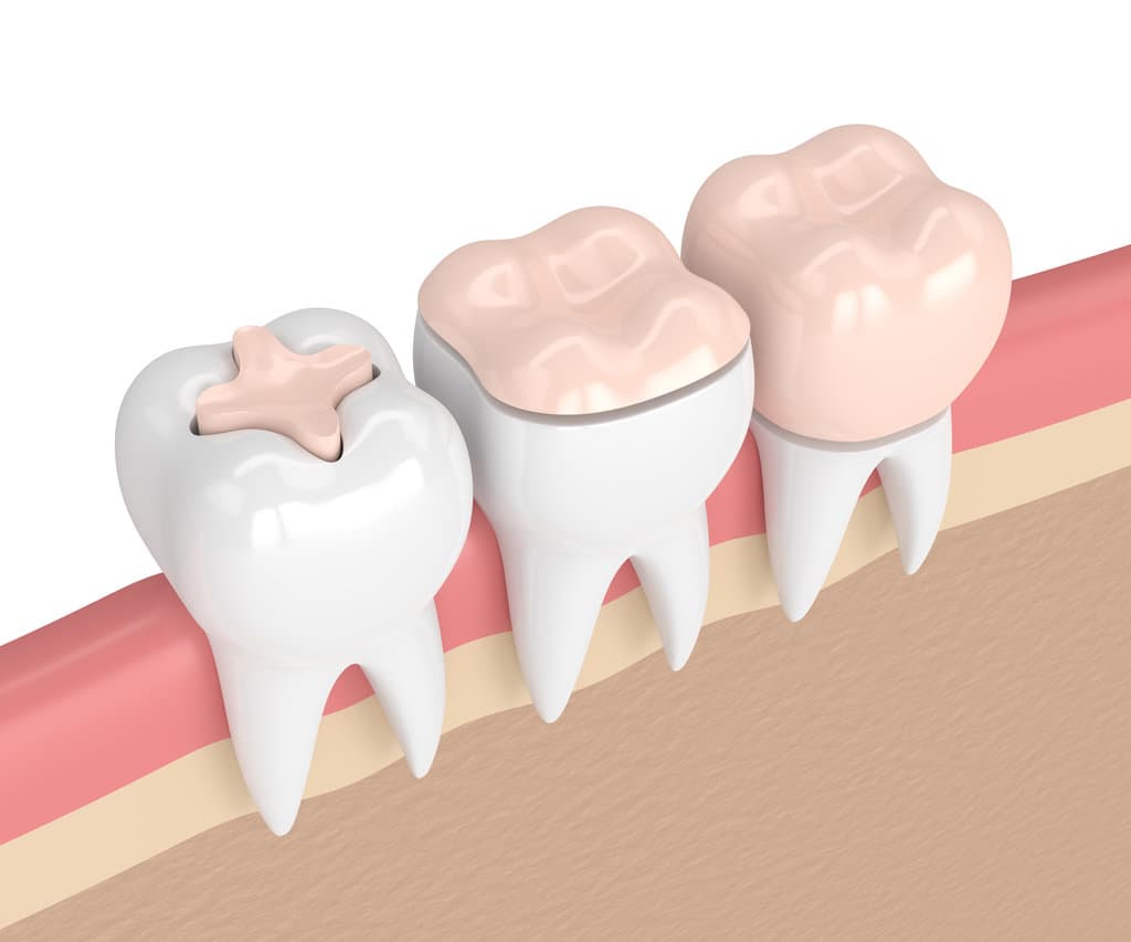 Crown Vs Filling