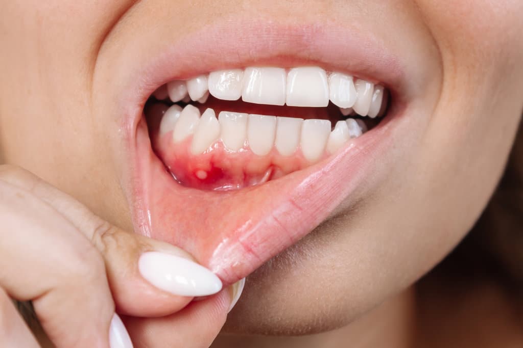 Ulcer on Gums