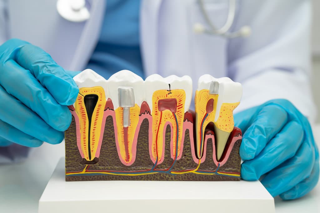 Root Canal Vs Implant