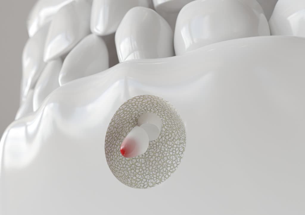 Root tip inflammation with apicectomy - 3D rendering