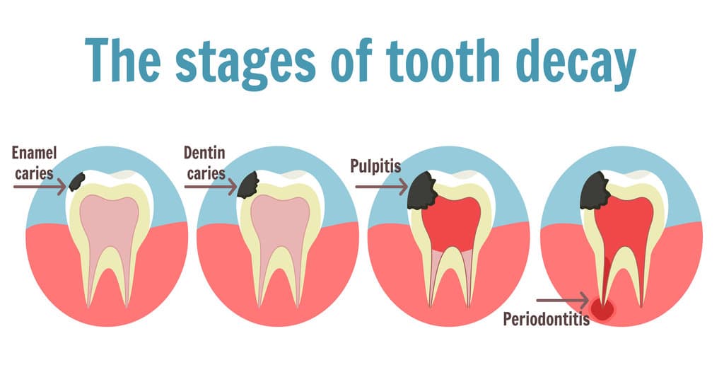 The stages of tooth decay infographic. Dental toothache symbol. Illustration of tooth with caries, pulpitis and periodontitis