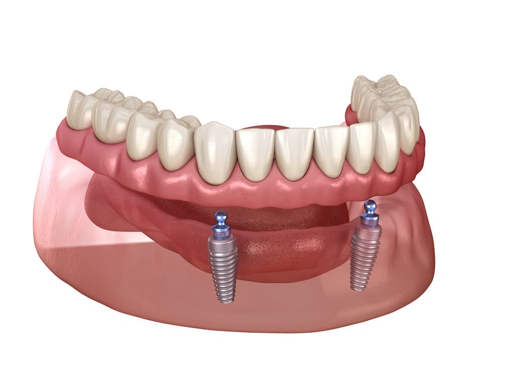 Removable Denture Implants