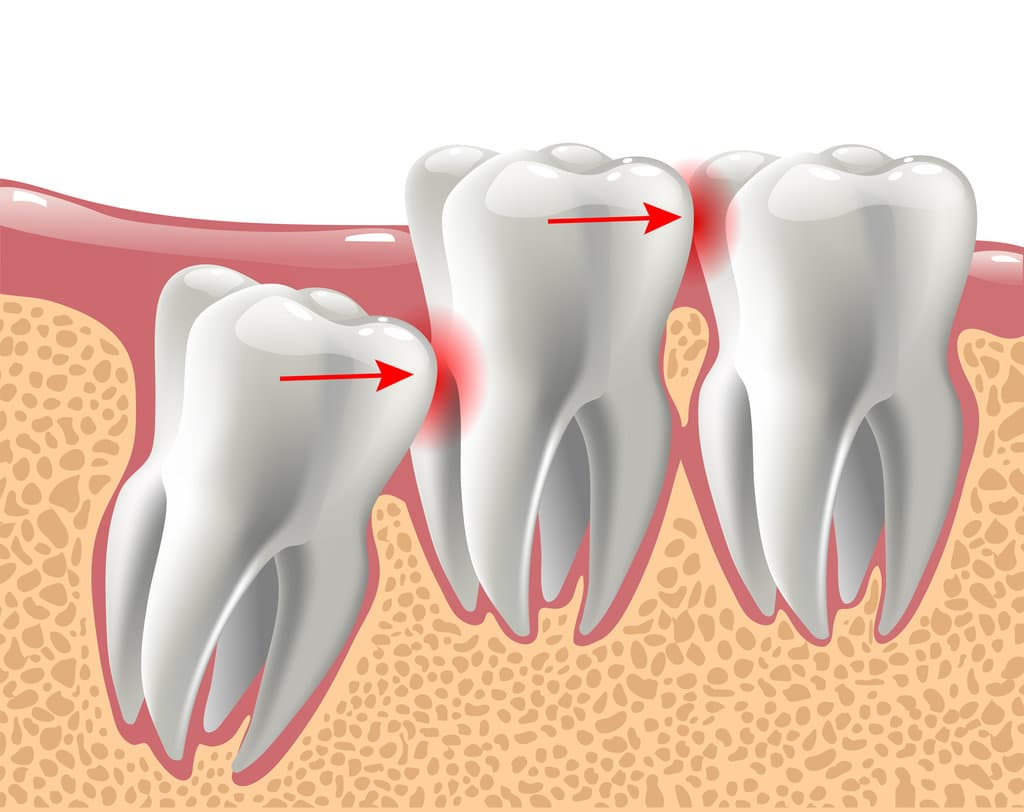 realistic 3D teeth, and wisdom tooth problems