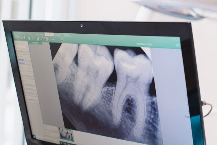 Guided Tissue Regeneration