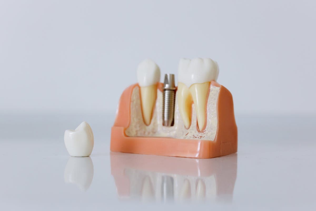 Close-Up Shot of Dental Implant Model.jpg