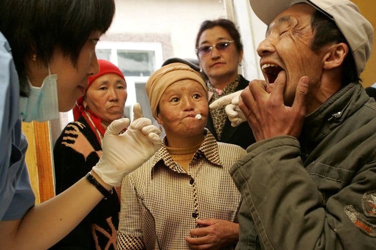 Why Do Wisdom Teeth Need to Be Taken Out