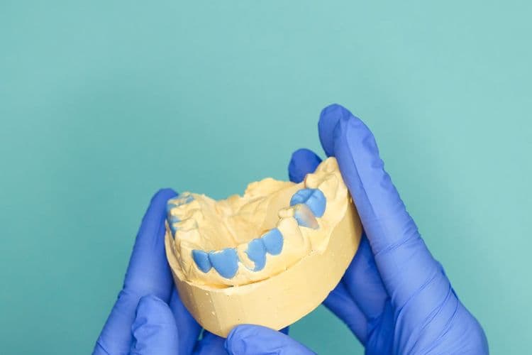 How Much Are Dental Impressions