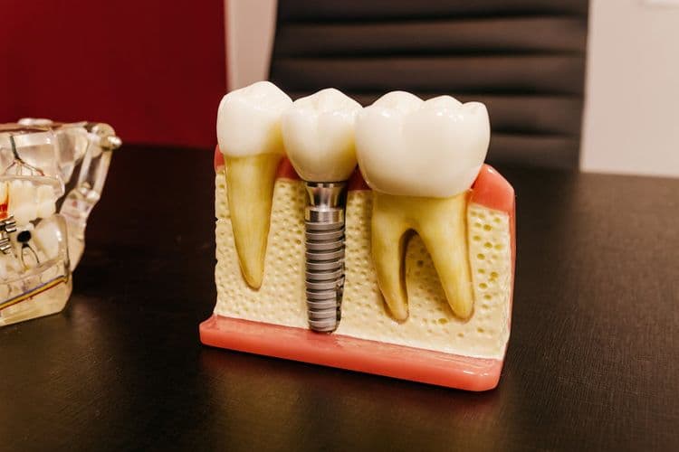 Best Material for Dental Implants
