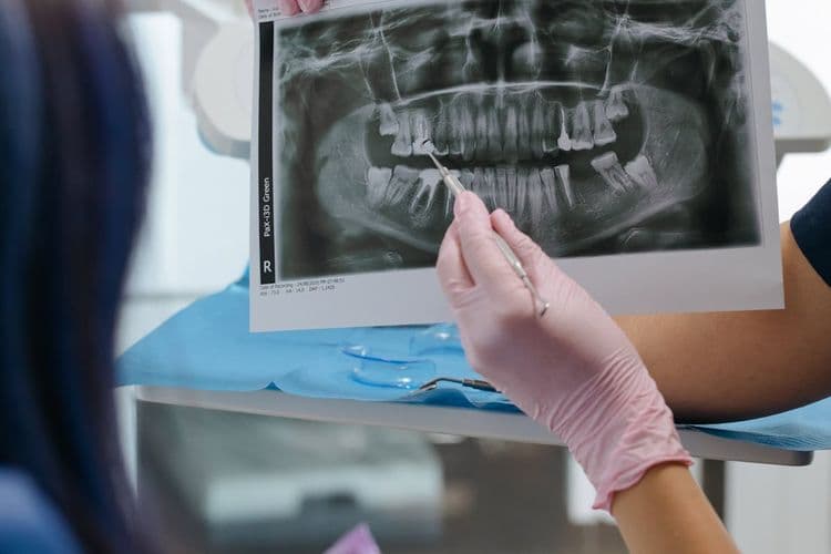 Zygomatic Dental Implants