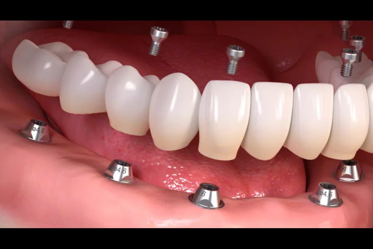 All on 6 - Radiant Dental