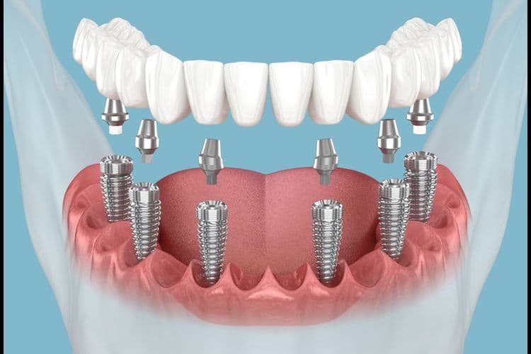All on 6 Implants