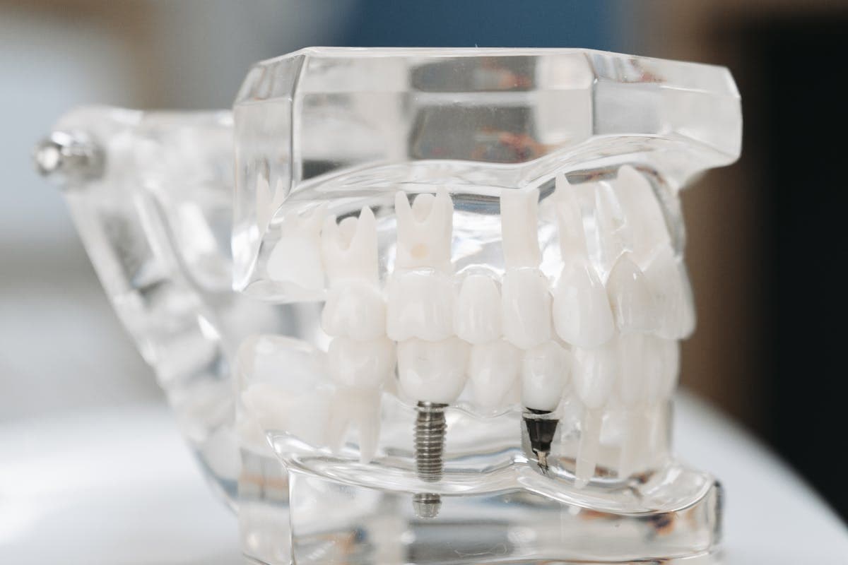 Transparent Dental Implant Model
