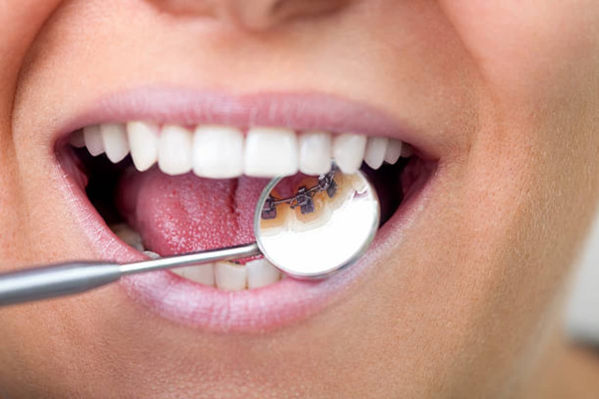 Dental Mirror Showing Lingual Braces