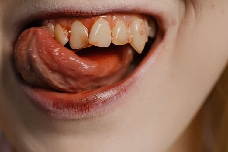 Hemorrhagic Teeth