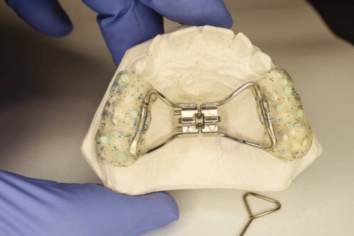 Hyrax Braces Wear On Patient Teeth Gypsum Model.jpg