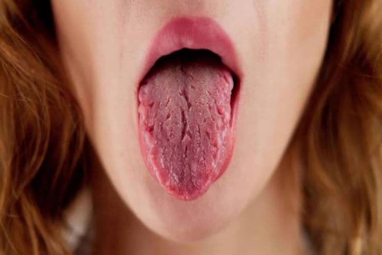 What Is Dehydrated Tongue