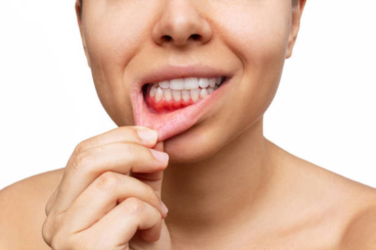 Gum Inflammation Cropped Shot Of A Young Woman Shows Red Bleeding Gums