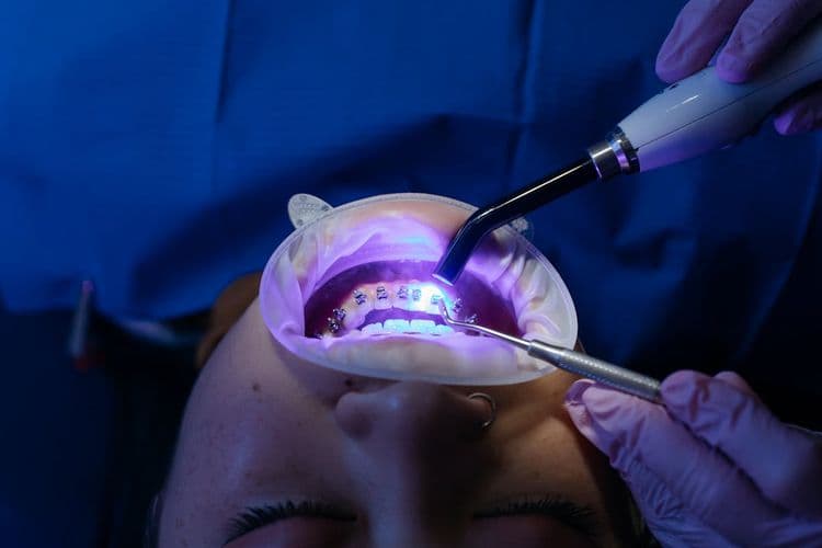 Plaque on Braces