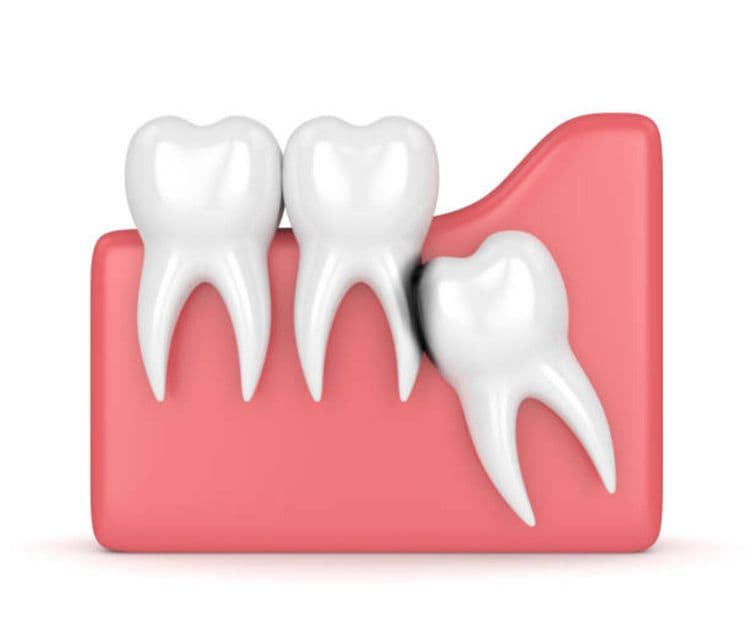 What Can I Eat After Wisdom Teeth Removal