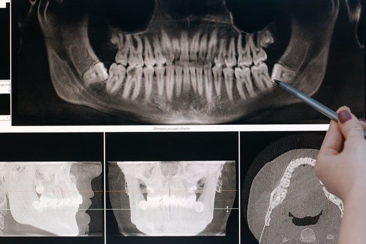Wisdom Tooth Removal Cost With Insurance