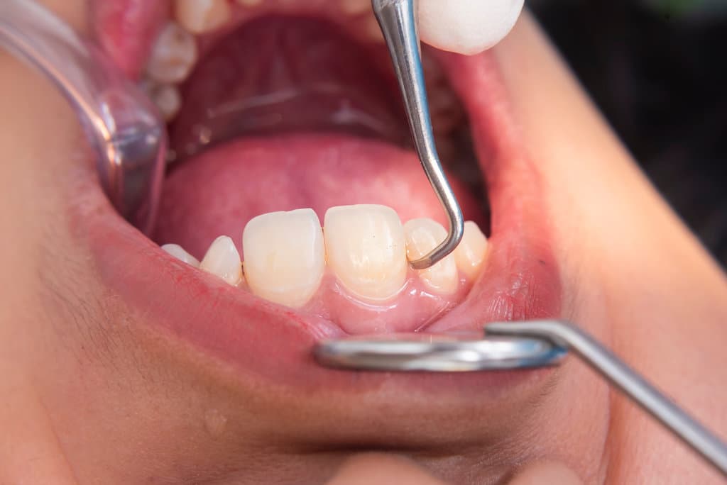 Macro image of dental scaling on lower anterior teeth using a metal scaler to remove plaque and calculus near the gum line.