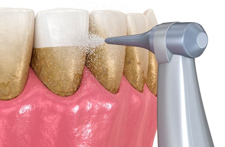 What Is Tartar on Teeth