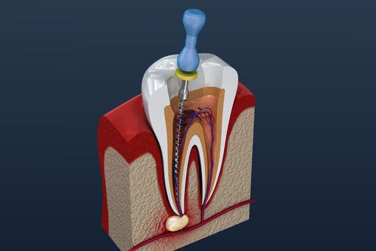 What Causes Root Canal