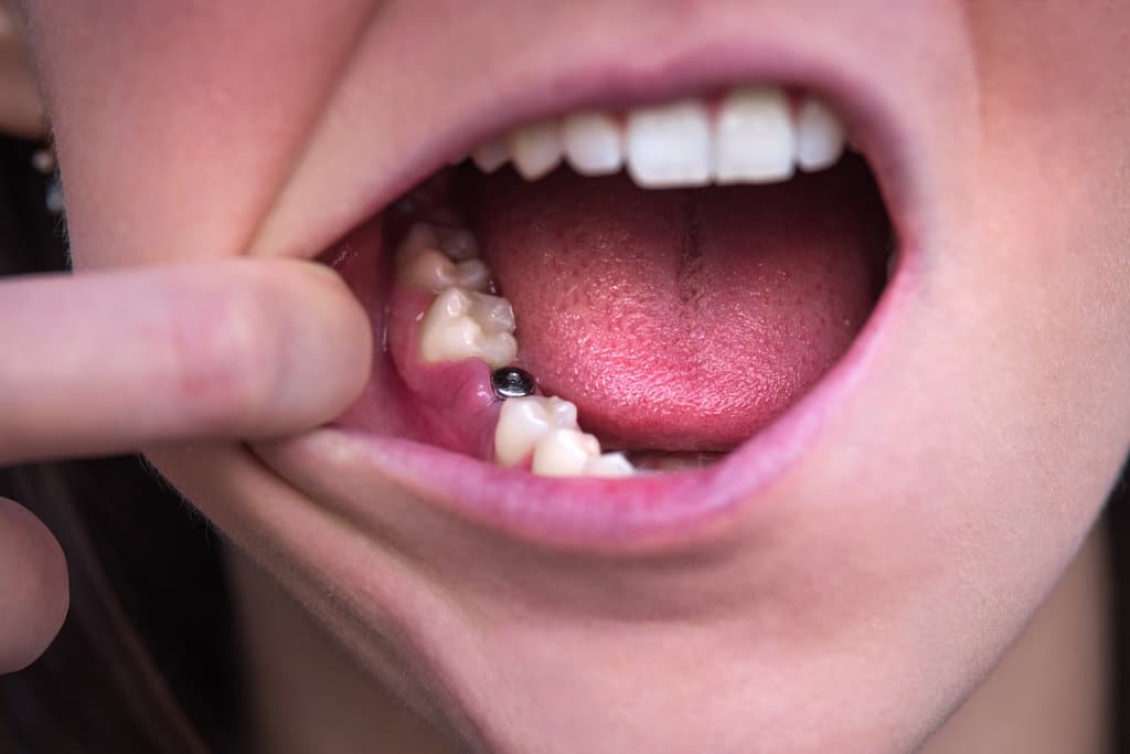 Single tooth implant. Young woman without tooth on lower jaw. Missing tooth. Implant after tooth extraction