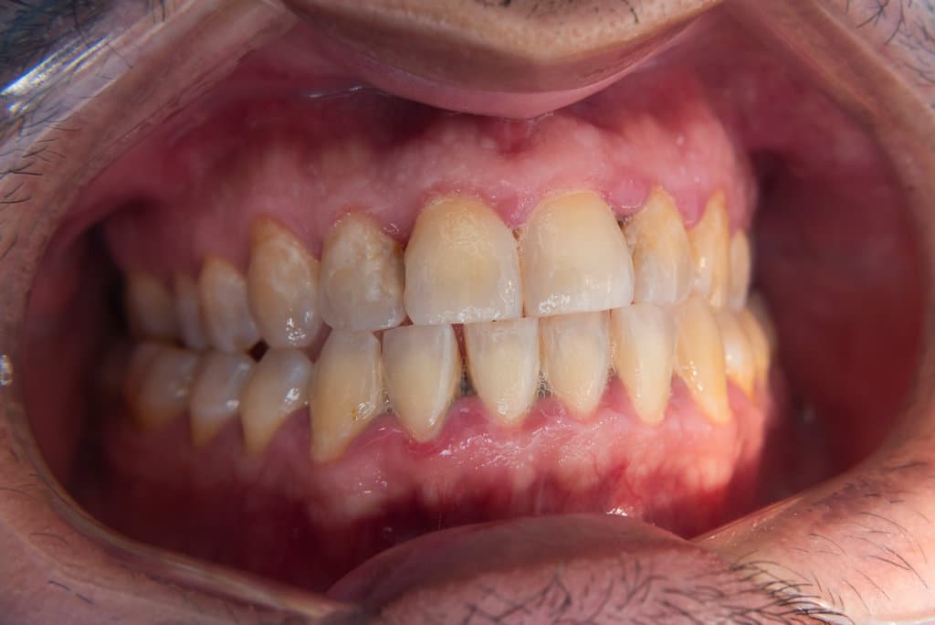 Macro dental photos showing plaque accumulation, mild enamel demineralization, and anterior crowding in adult male patient’s teeth, prior to oral prophylaxis.