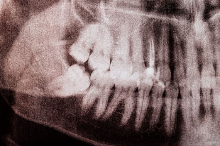 Can You Drink Alcohol After Wisdom Teeth Removal