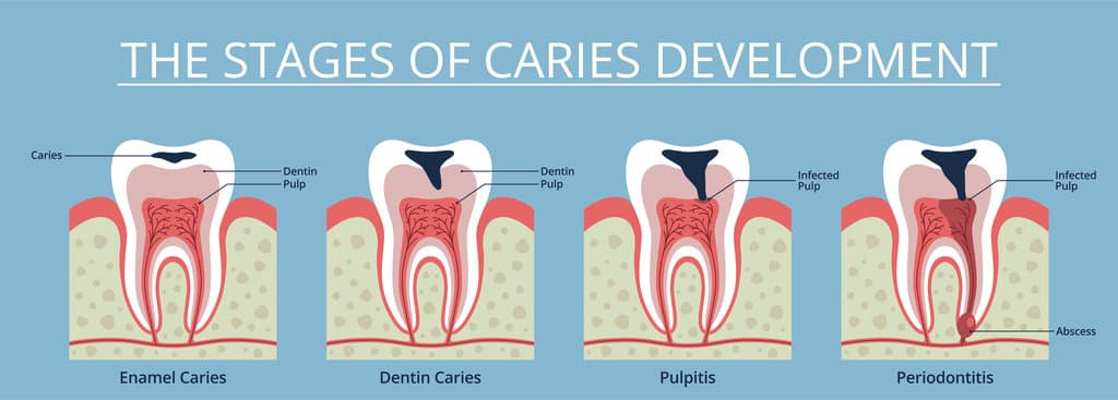 Caries stages. Gradual tooth decay process, enamel integrity violation, dental educational scheme, toothache medical poster, stomatology clinic infographics banner nowaday