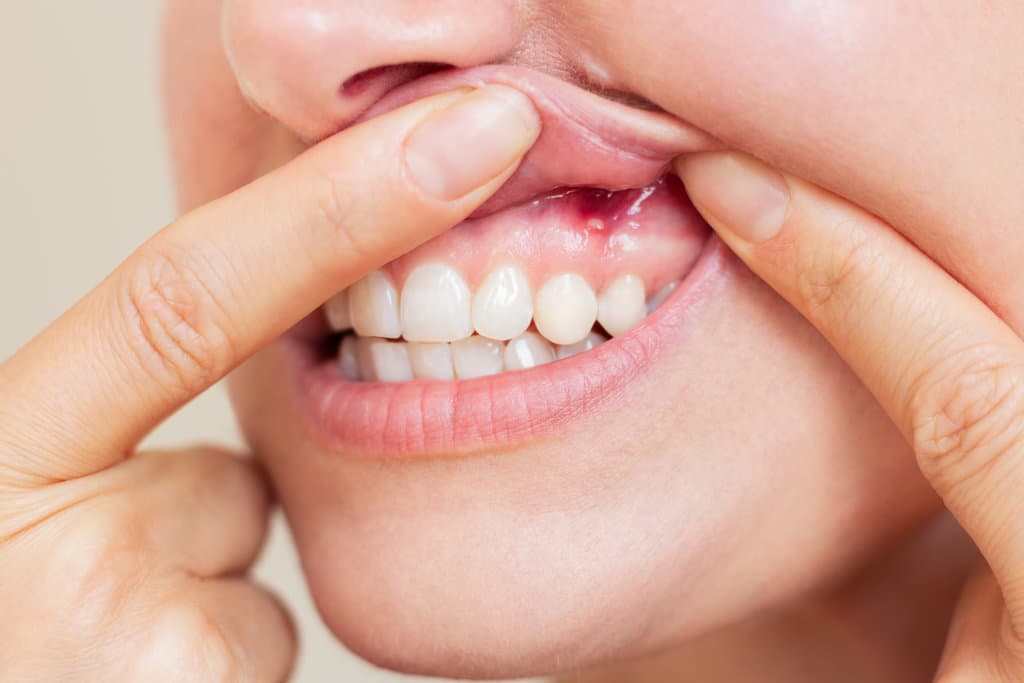 A young woman suffering from stomatitis showing her gums with an inflamed ulcer on the mucous membrane in close-up