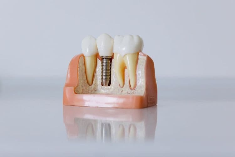 Dental Implants Types