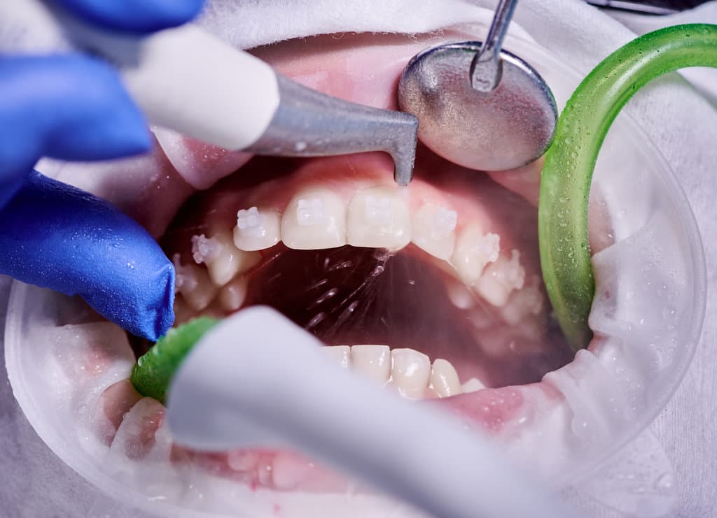 Macro photography. Cleaning process in patient's mouth with cheek retractor and brackets on teeth. Cleansing teeth with water jet and saliva ejector. Concept of professional dental hygiene