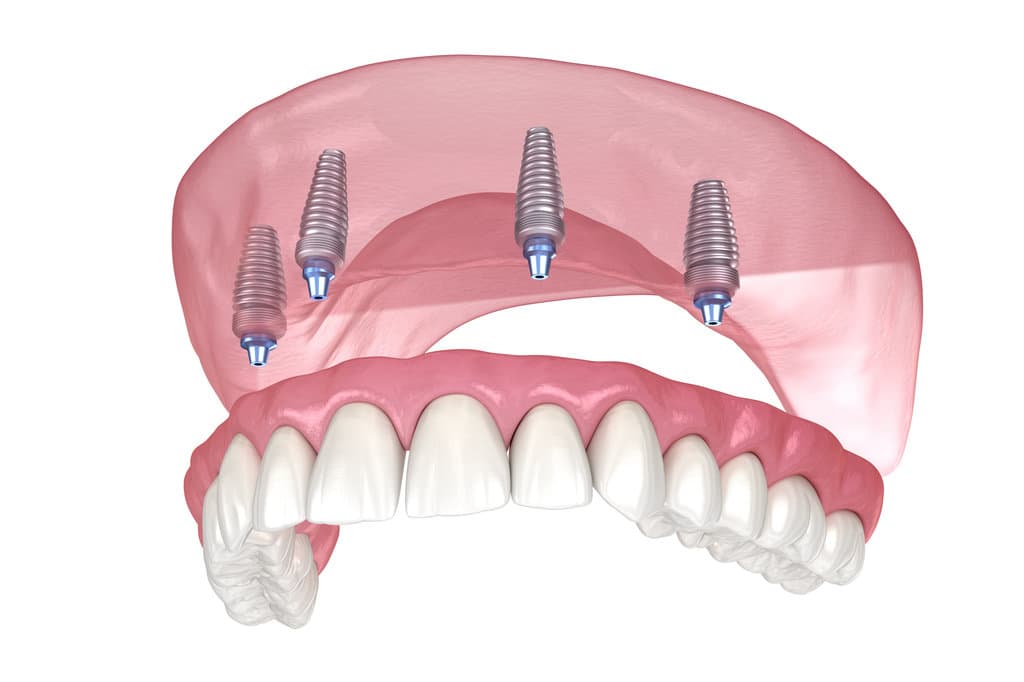Maxillary prosthesis with gum All on 4 system supported by implants. Medically accurate 3D illustration of human teeth and dentures