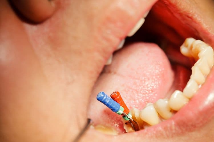 Root Canal Infection Symptoms