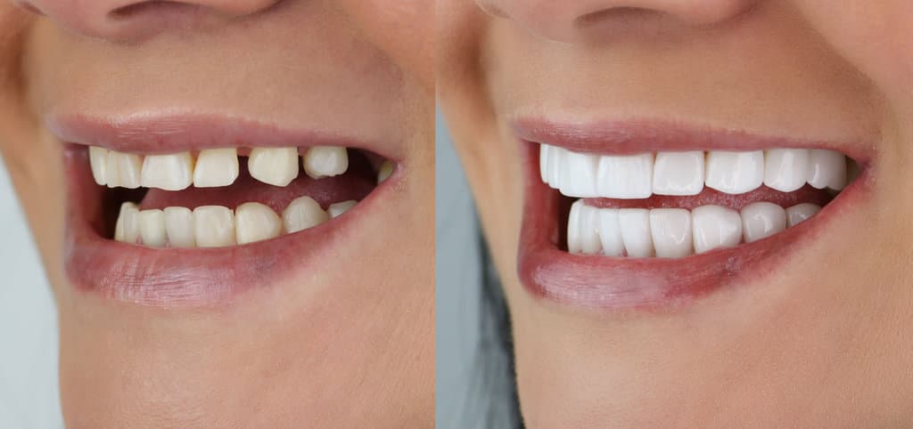 smile makeover porcelain laminated veneers result