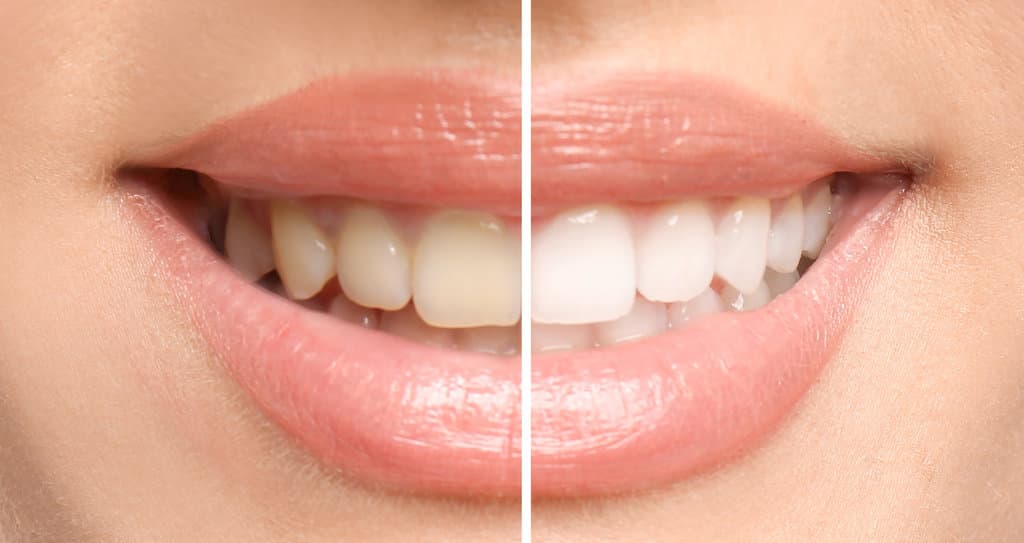 How Long Does Professional Teeth Whitening Last