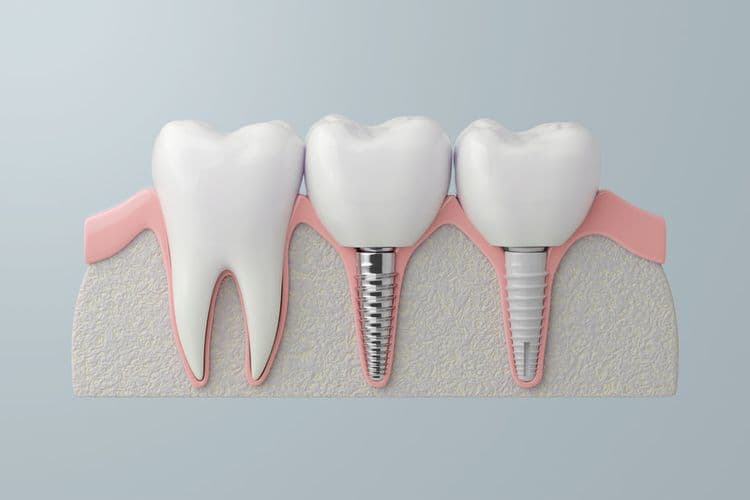 Dental Implants Longevity