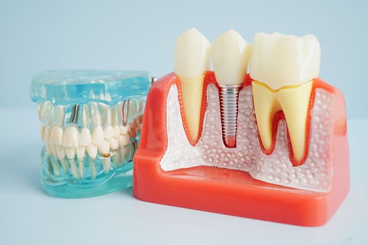 How Long Do Tooth Implants Last