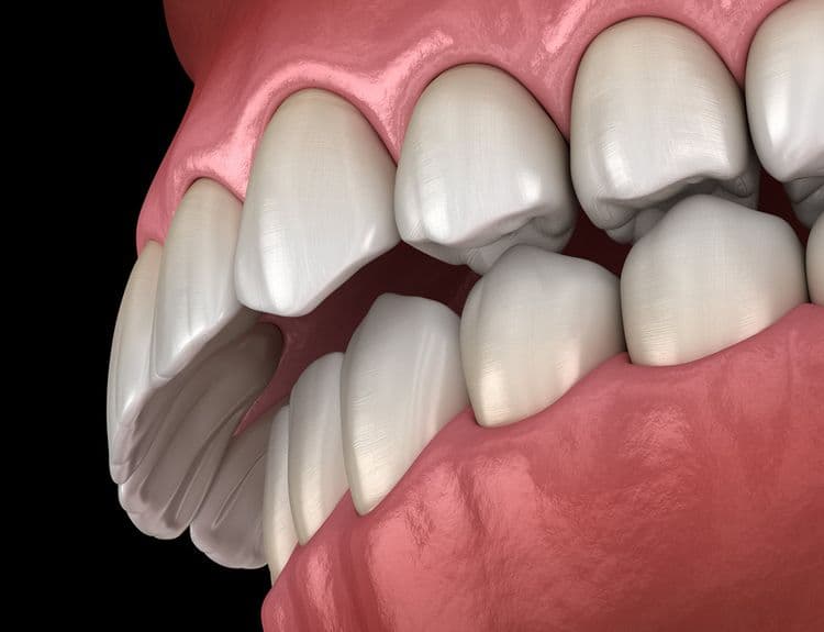 Can You Fix an Overbite Without Braces