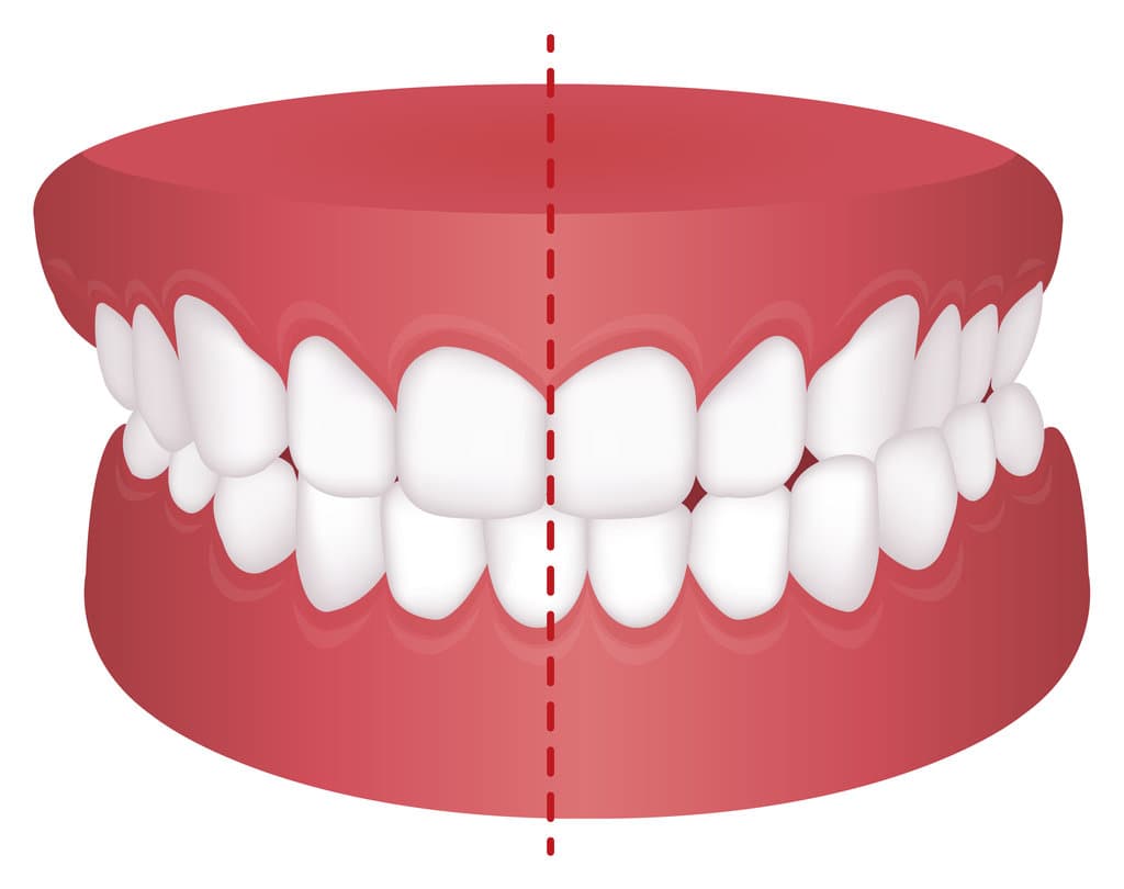 Types of Crossbite
