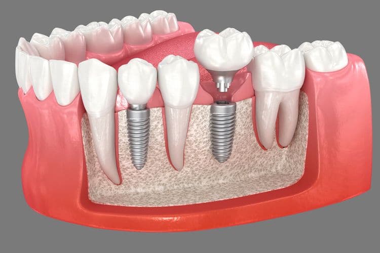 Molar Dental Implant