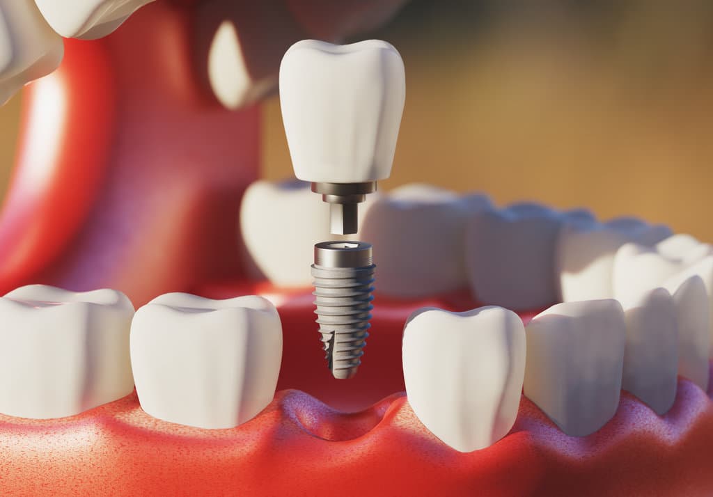 Dental Implant Removal Recovery Time